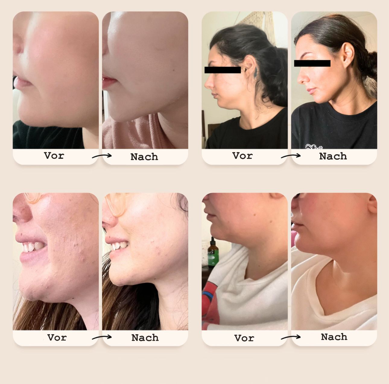 V-förmige Hebemaske mit verstellbarem Doppelkinnriemen für Frauen